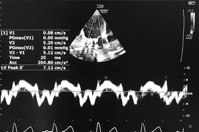 Subclinical Left Ventricular Dysfunction in Children and Adolescence With Thalassemia Intermedia